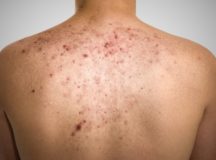 Acne adulta: causas e tratamentos