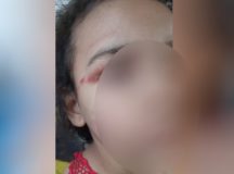 Menina de 6 anos é agredida no rosto pelo namorado da mãe dela que estava bêbado, diz conselheiro