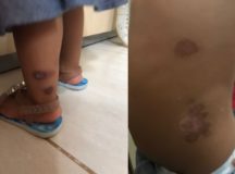 Padrasto é preso suspeito de agredir e queimar com cigarro menina de 1 ano no DF